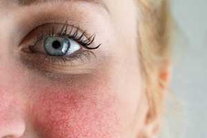 Advancing cosmetic safety testing for rosacea-prone skin