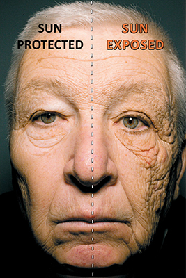 Dermscan discusses photoageing and how to assess it