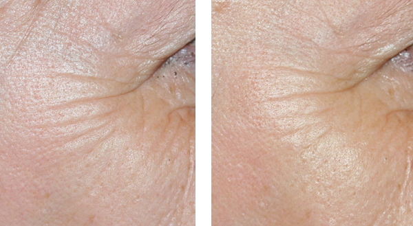 Elix-IR: The elixir of youth to fight Infra’aging