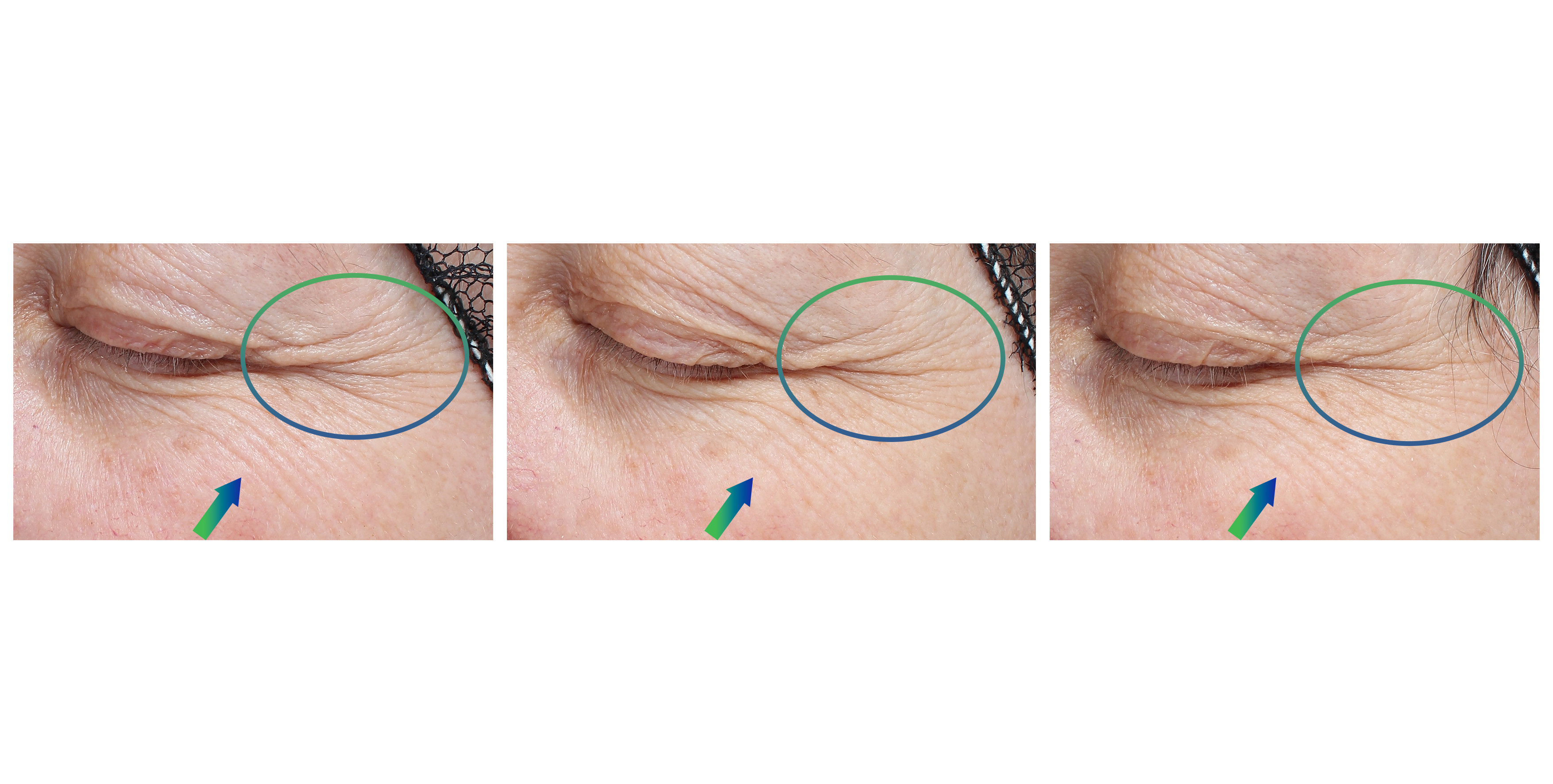 Epitensive, intensive antiaging plant-EGF