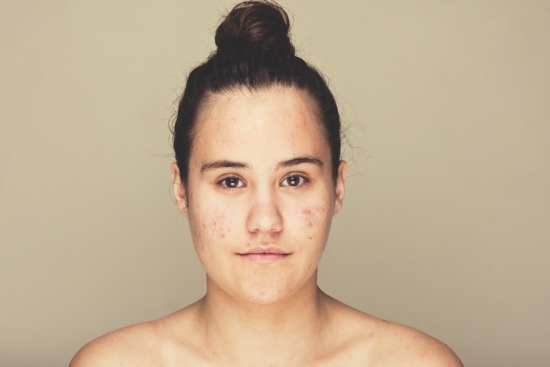 Frezyderm creates website to support acne sufferers