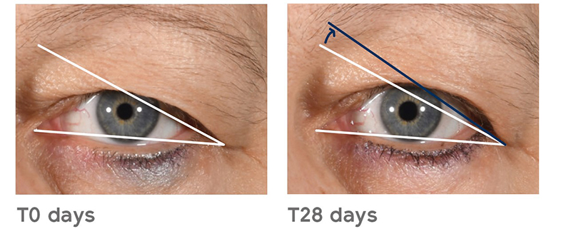 Fig 2. Opening of the eye