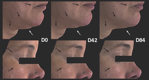 Figure 4 Liftonin-Xpert visibly improves wrinkles in the eye and neck areas and lifts sagging skin