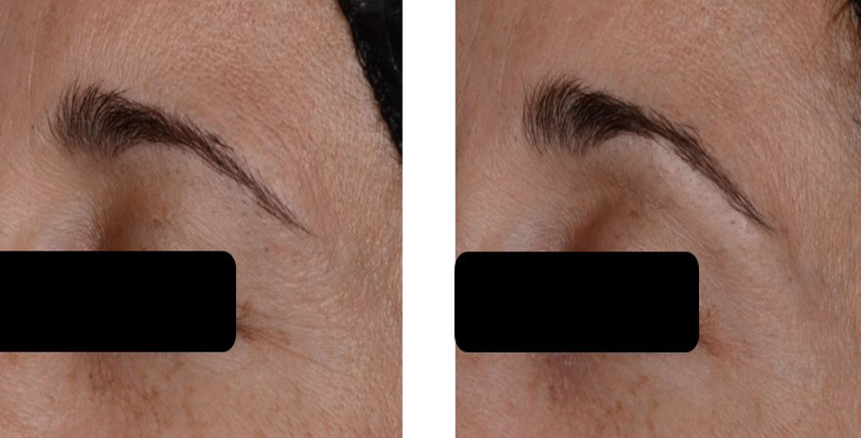 0 days vs 28 days