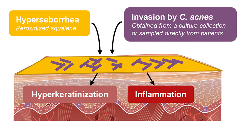 Silab has developed a 3D model mimicking acneic skin