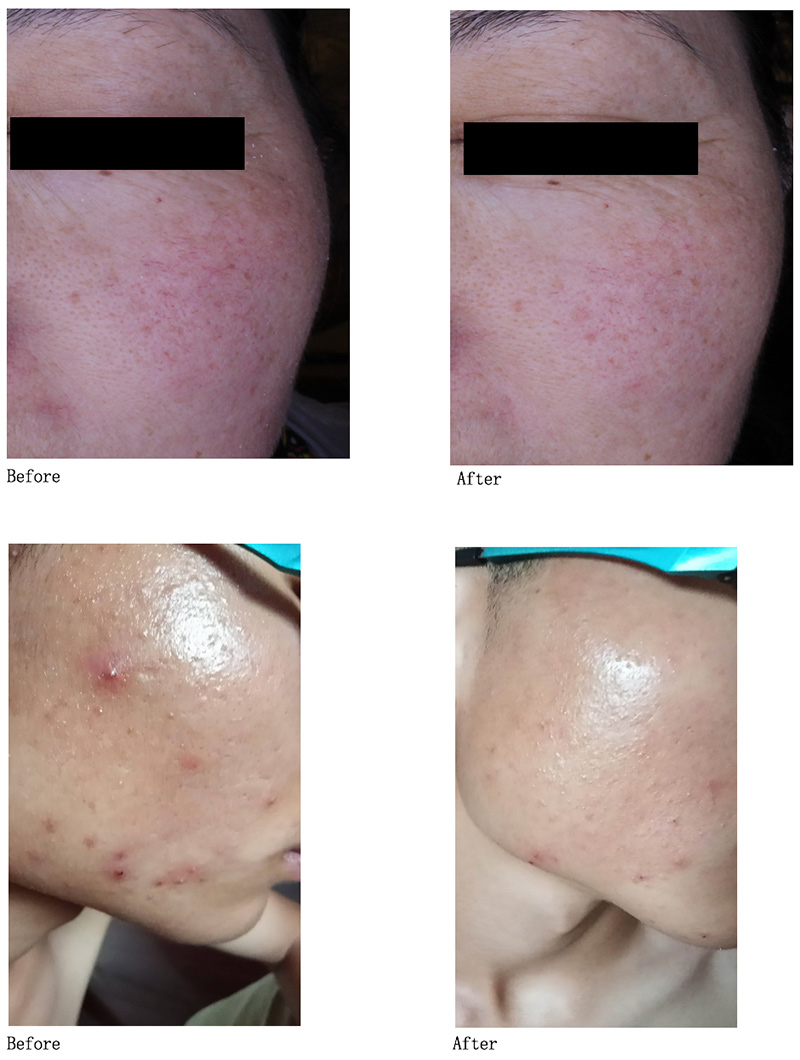 Spec-Chem Industry Inc. shares the results of acne repairing lotion