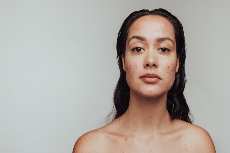Meet the new breed of blemish-busting ingredients for grown-ups