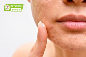 Much longed for: MyMicrobiome launches Derm Standard for Skin Microbiome in Acne