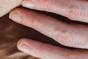 New way to describe skin colours will combat underrepresentation in research
