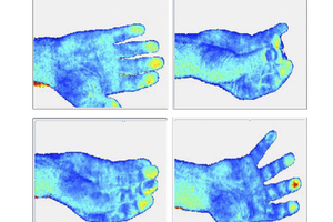Tissue Viability Imaging for quantitative user-independent assessment