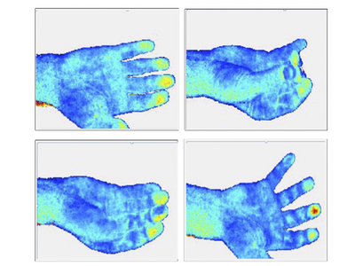 Tissue Viability Imaging for quantitative user-independent assessment