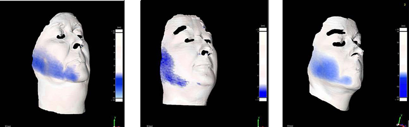 IMAGE 2: Facial Countour Remodeling
