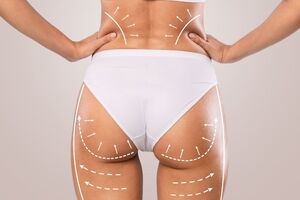Women and Equalities Committee urges UK Government for urgent ‘de facto ban’ on BBLs
